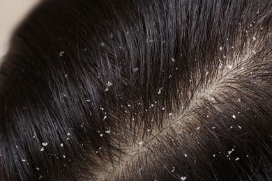 Image of Woman with dandruff in her dark hair, closeup view