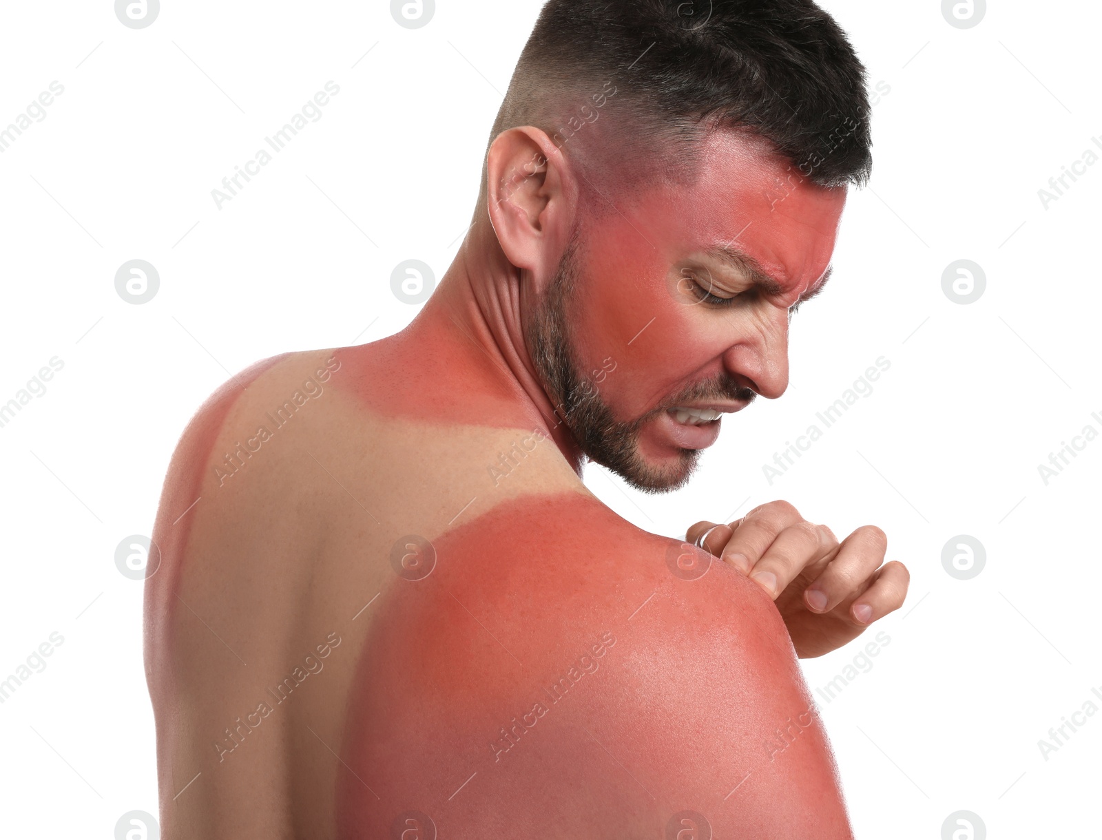 Photo of Man with sunburned skin on white background