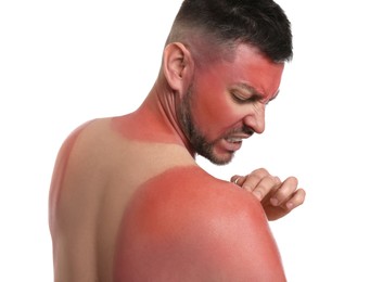 Man with sunburned skin on white background