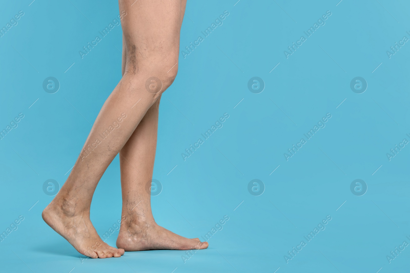 Photo of Closeup view of woman with varicose veins on light blue background. Space for text