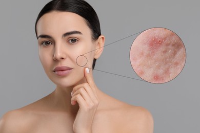 Image of Dermatology. Woman with skin problem on grey background. Zoomed area showing acne