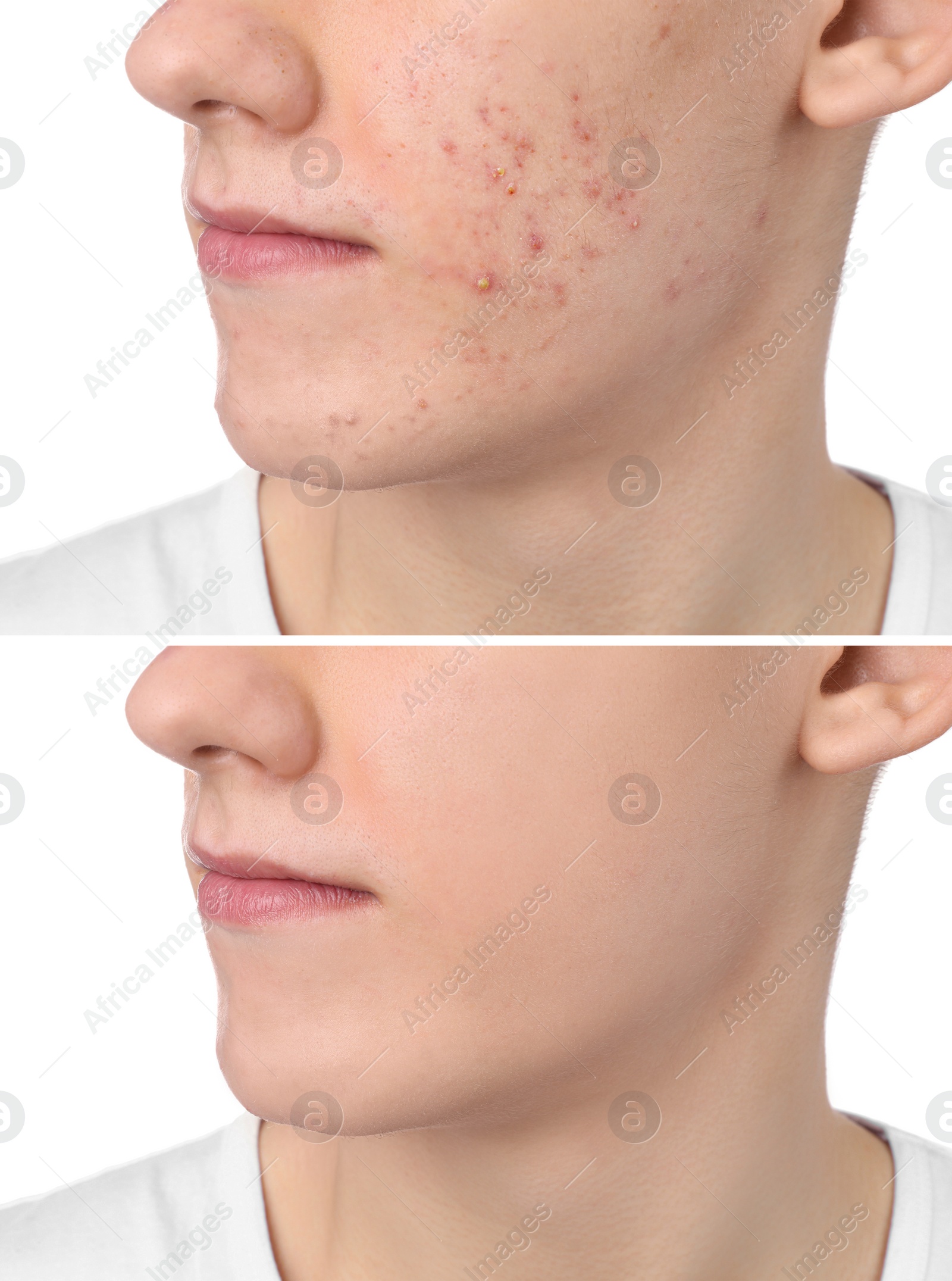 Image of Acne problem. Young man before and after treatment on white background, closeup. Collage of photos