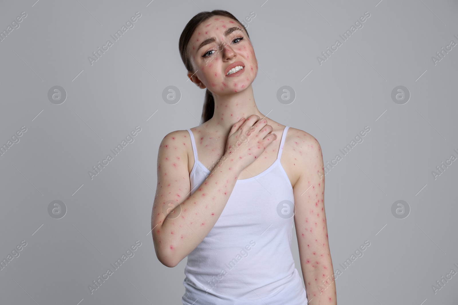 Photo of Woman with rash suffering from monkeypox virus on light grey background