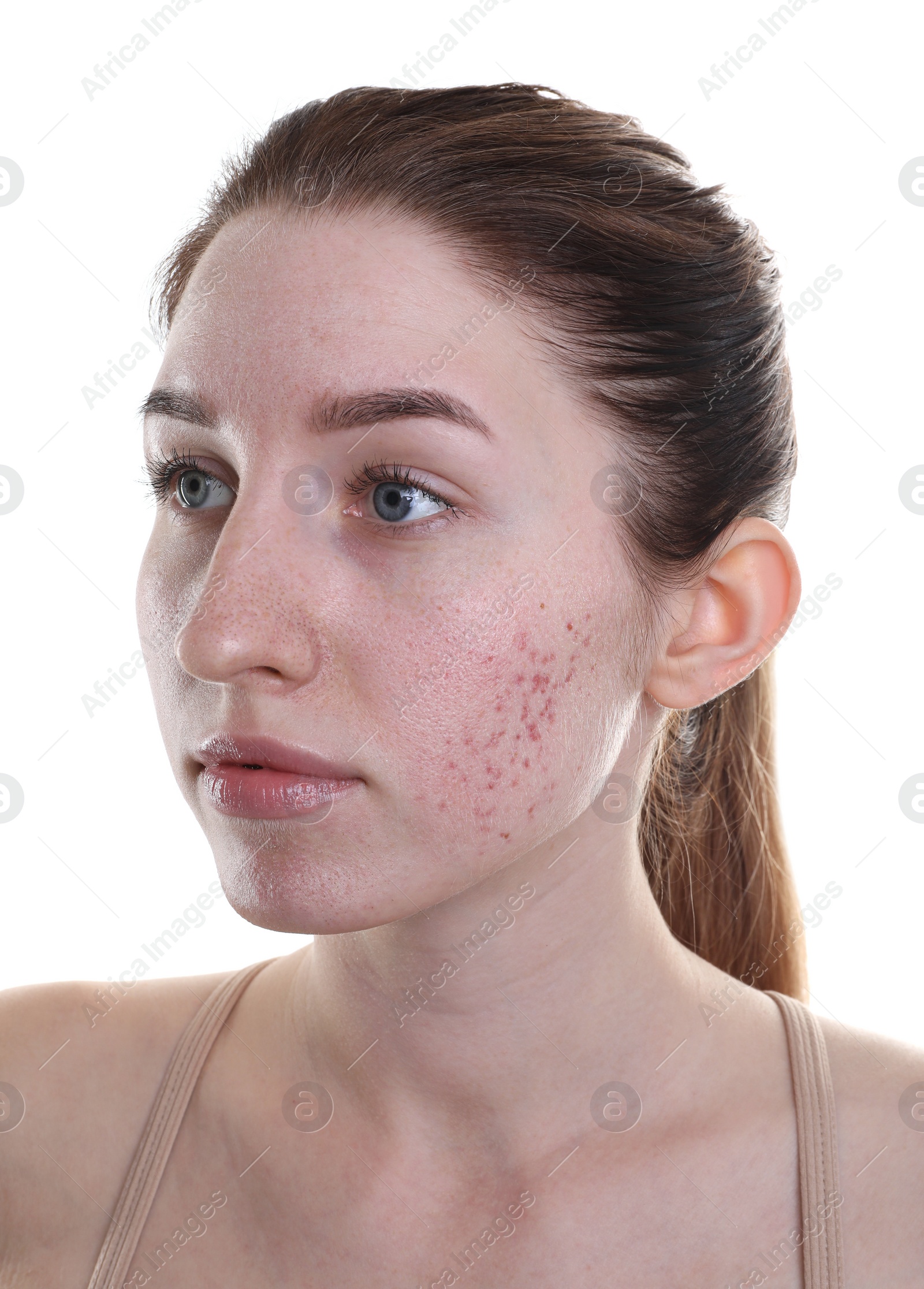 Photo of Young woman with acne problem on white background