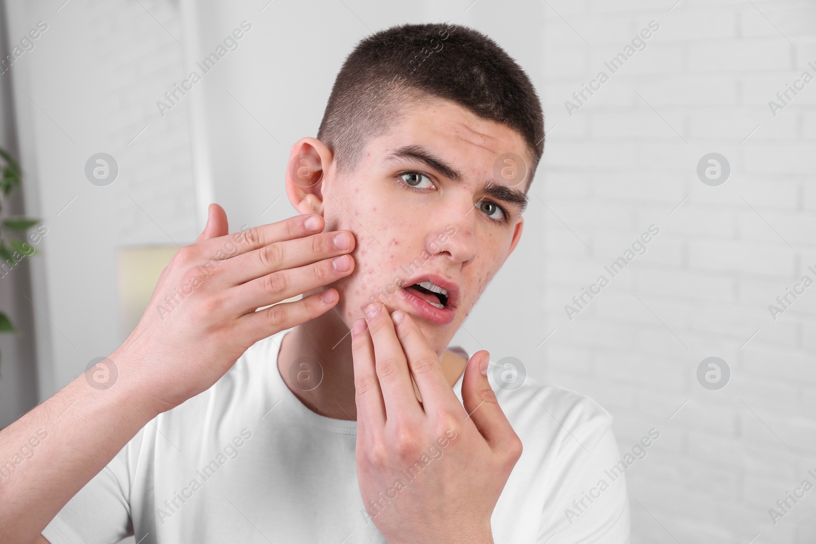 Photo of Upset young man touching pimple on his face indoors. Acne problem