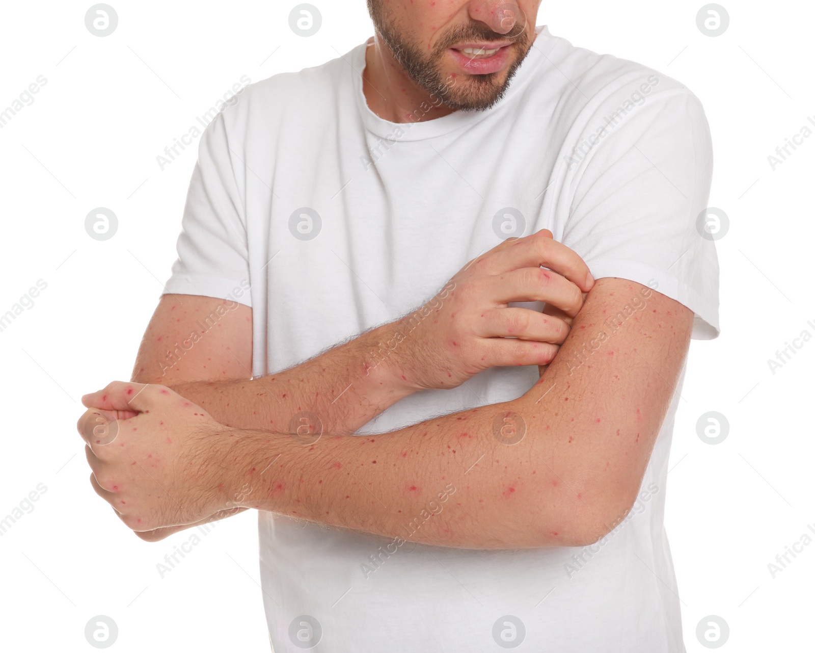 Photo of Man with rash suffering from monkeypox virus on white background, closeup