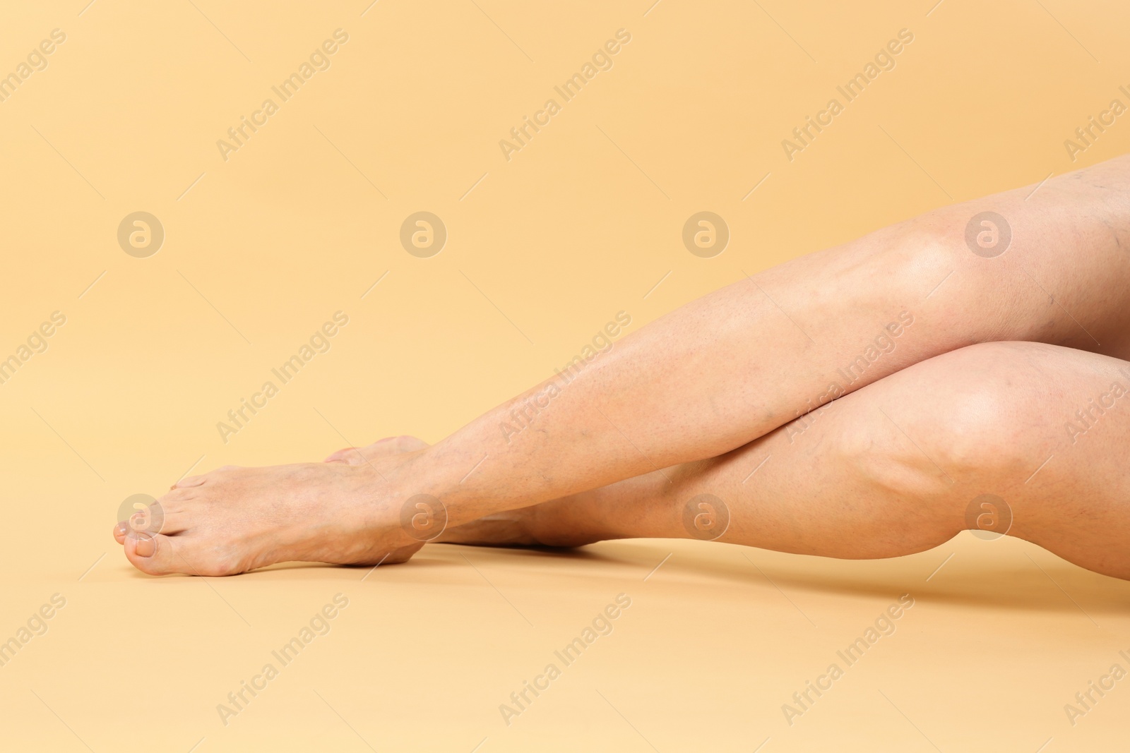 Photo of Closeup view of woman with varicose veins on yellow background