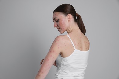 Photo of Woman with rash suffering from monkeypox virus on light grey background