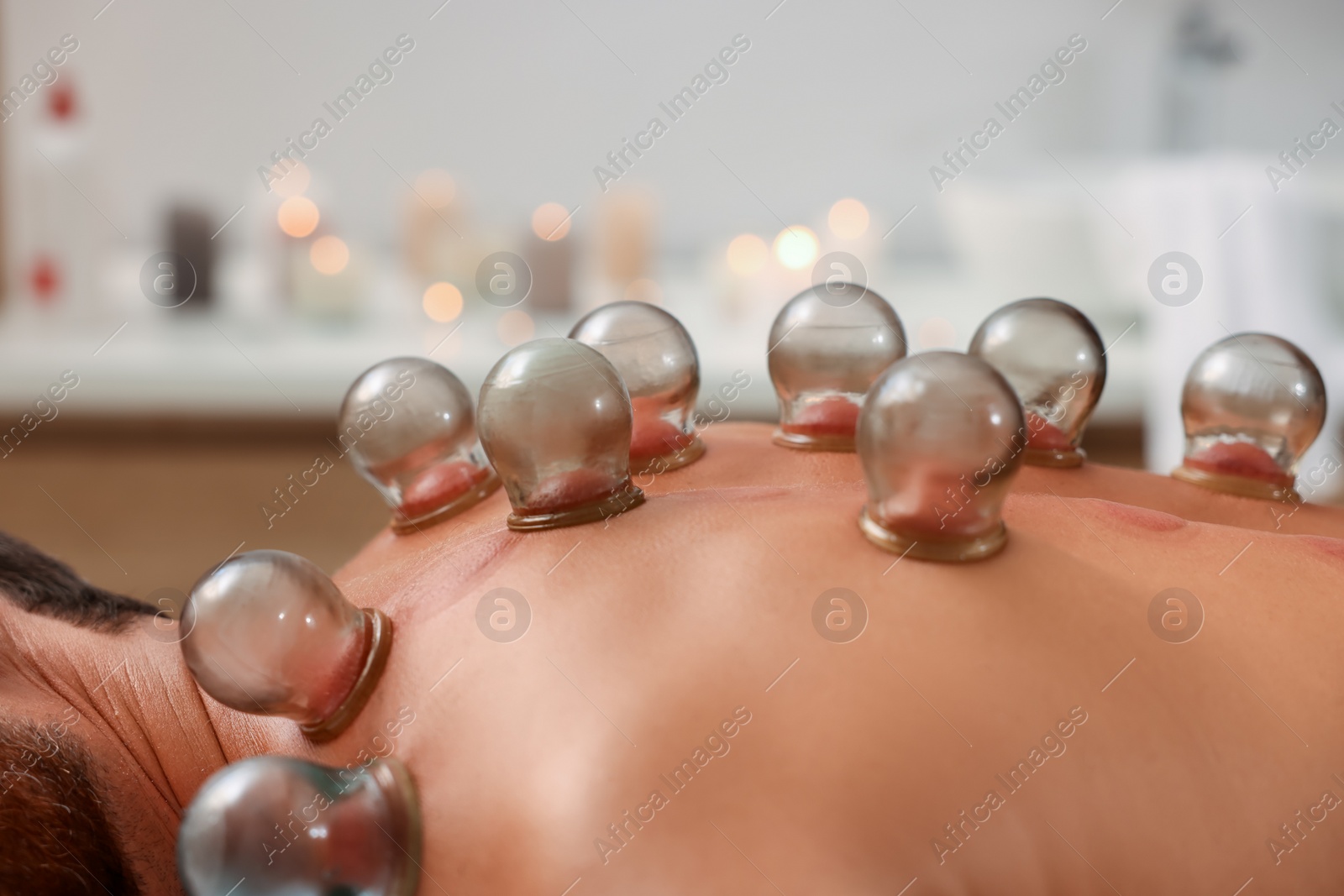 Photo of Cupping therapy. Closeup view of man with glass cups on his back indoors