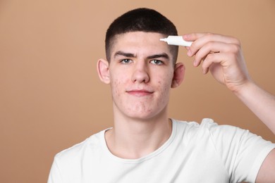 Young man with acne problem applying cosmetic product onto his skin on beige background. Space for text