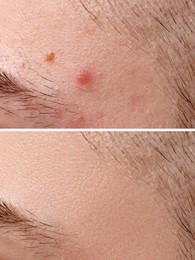 Image of Collage with photos of man with acne problem before and after treatment, closeup