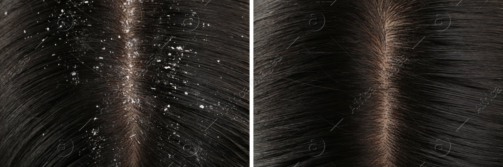 Image of Woman showing hair before and after dandruff treatment, collage