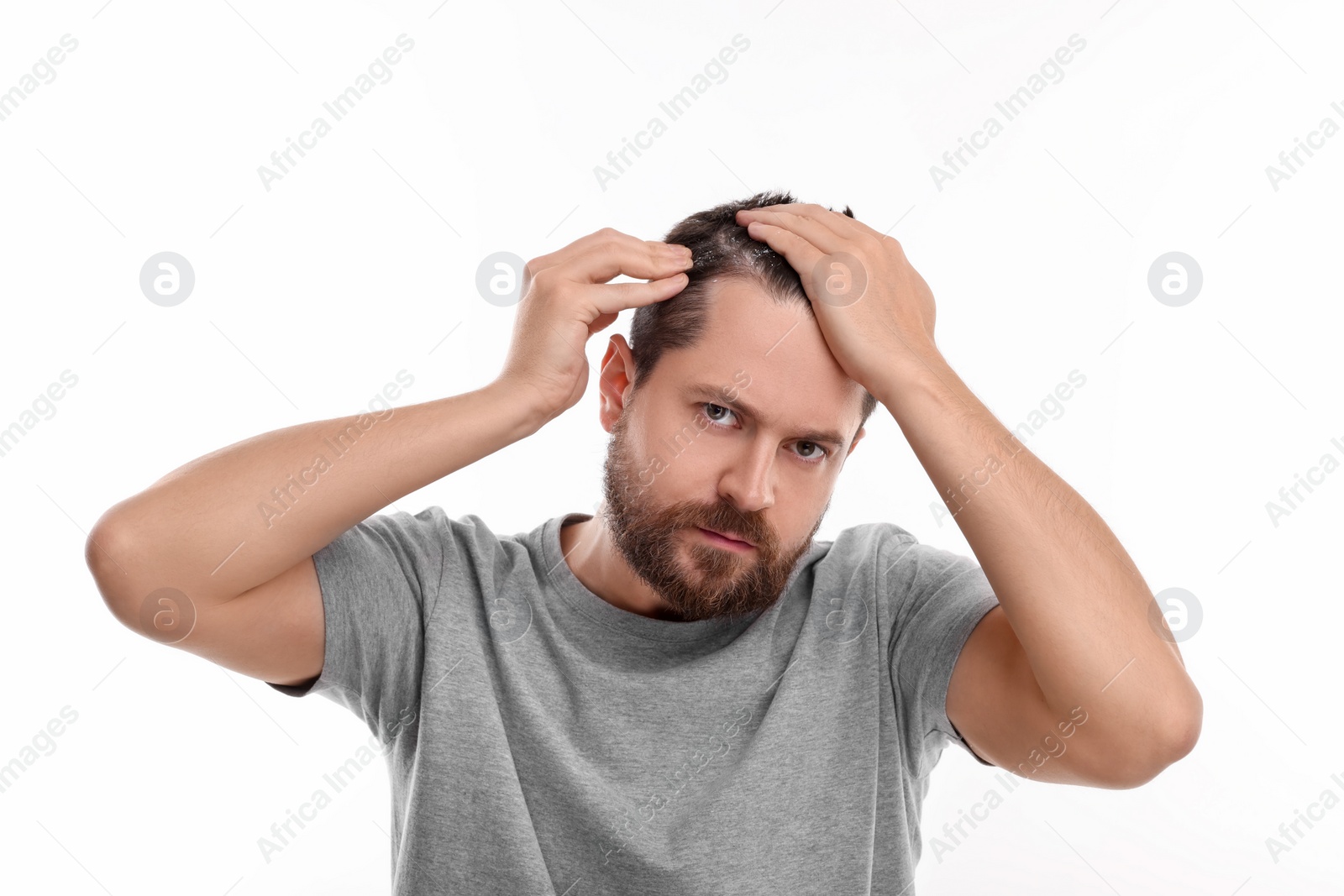 Photo of Man with dandruff in his dark hair on white background