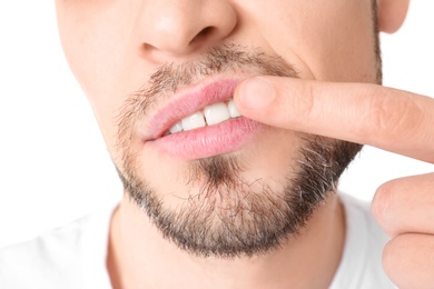 Photo of Man with cold sore touching lips on white background, closeup