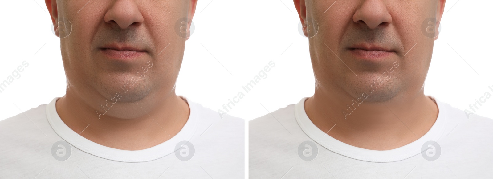 Image of Mature man before and after plastic surgery operation on white background, closeup. Double chin problem