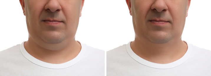 Image of Mature man before and after plastic surgery operation on white background, closeup. Double chin problem