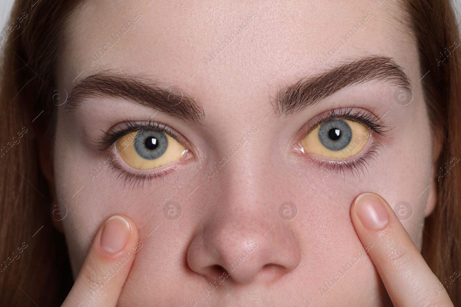 Photo of Woman with yellow eyes on white background, closeup. Symptom of hepatitis