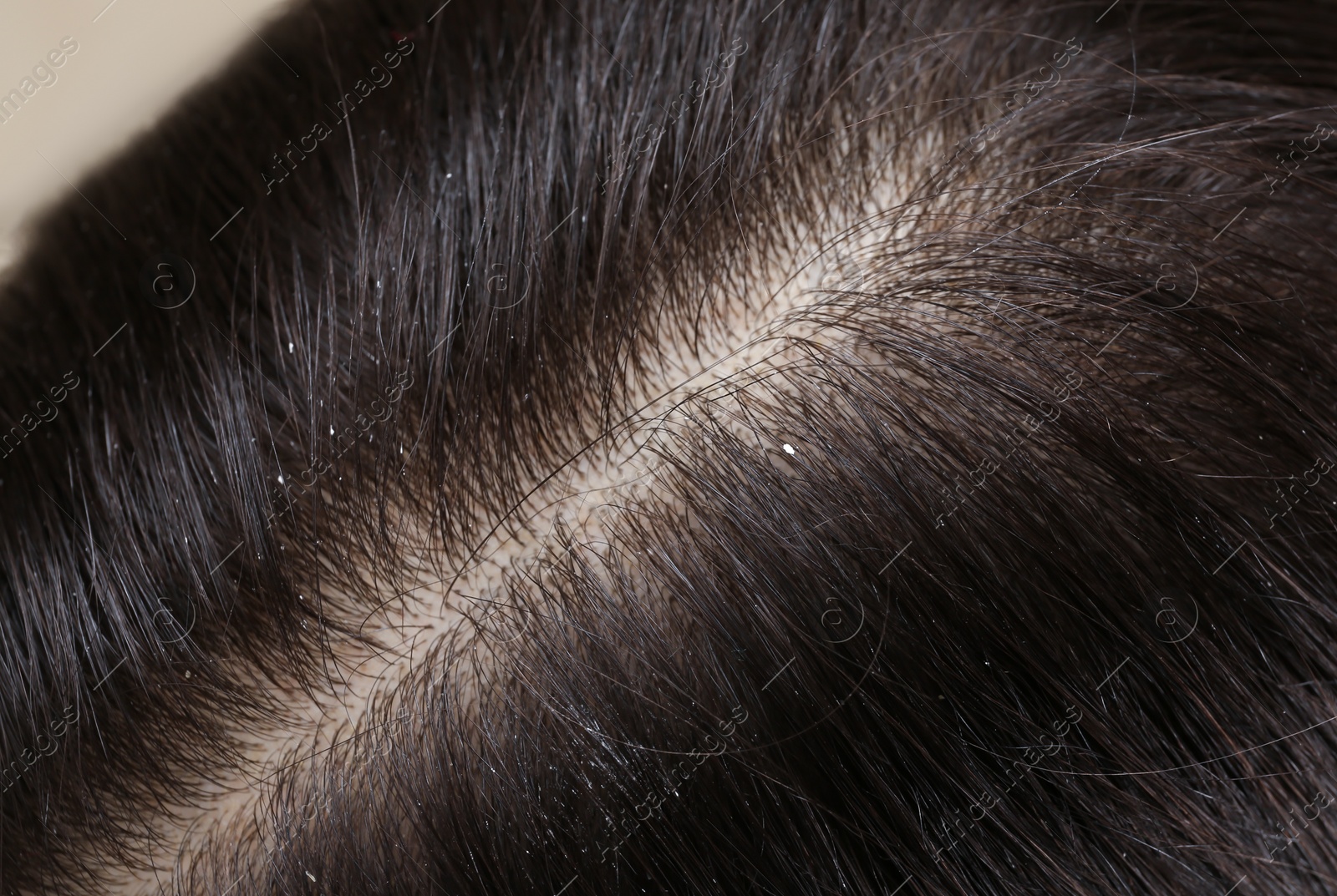 Photo of Woman with dandruff in her dark hair, closeup view