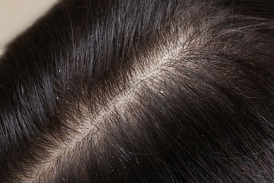 Photo of Woman with dandruff in her dark hair, closeup view