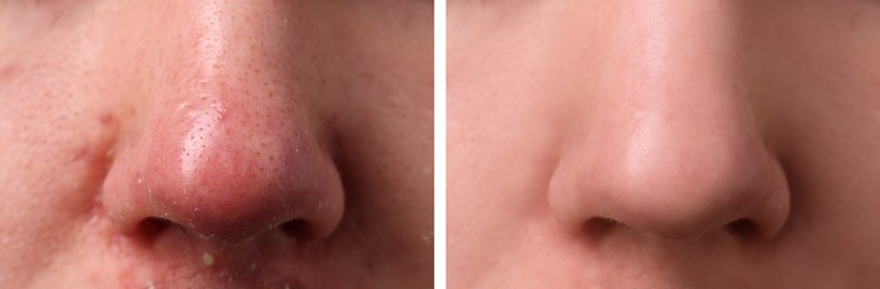 Image of Photos of man before and after acne treatment, closeup. Collage showing affected and healthy skin