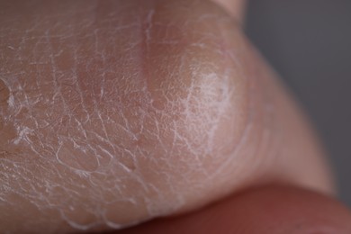 Photo of Woman with dry skin on hand, macro view