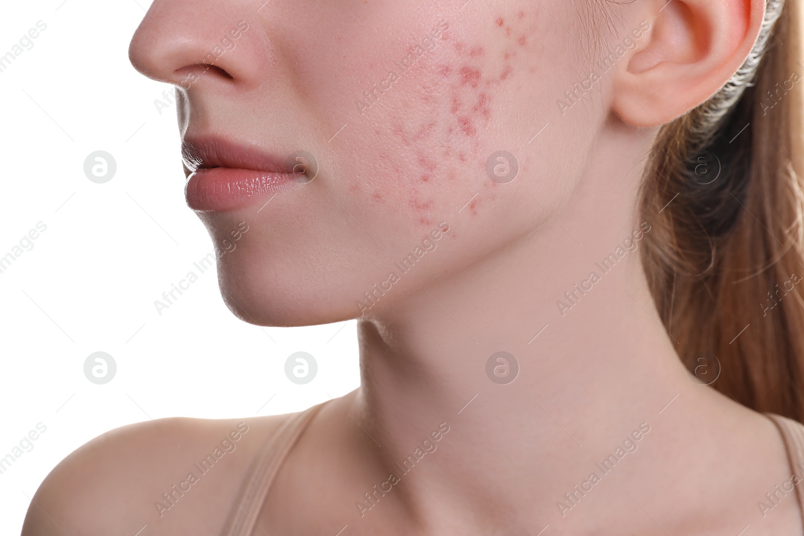 Photo of Young woman with acne problem on white background, closeup