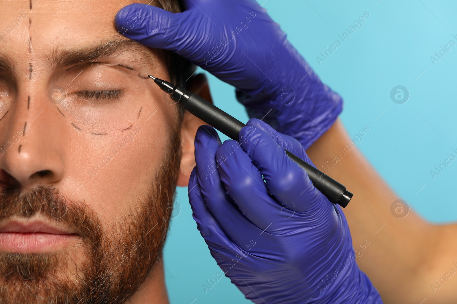 Photo of Doctor preparing patient for cosmetic surgery operation on light blue background, closeup