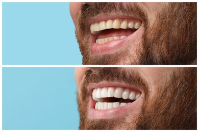 Image of Man showing teeth before and after whitening on light blue background, collage