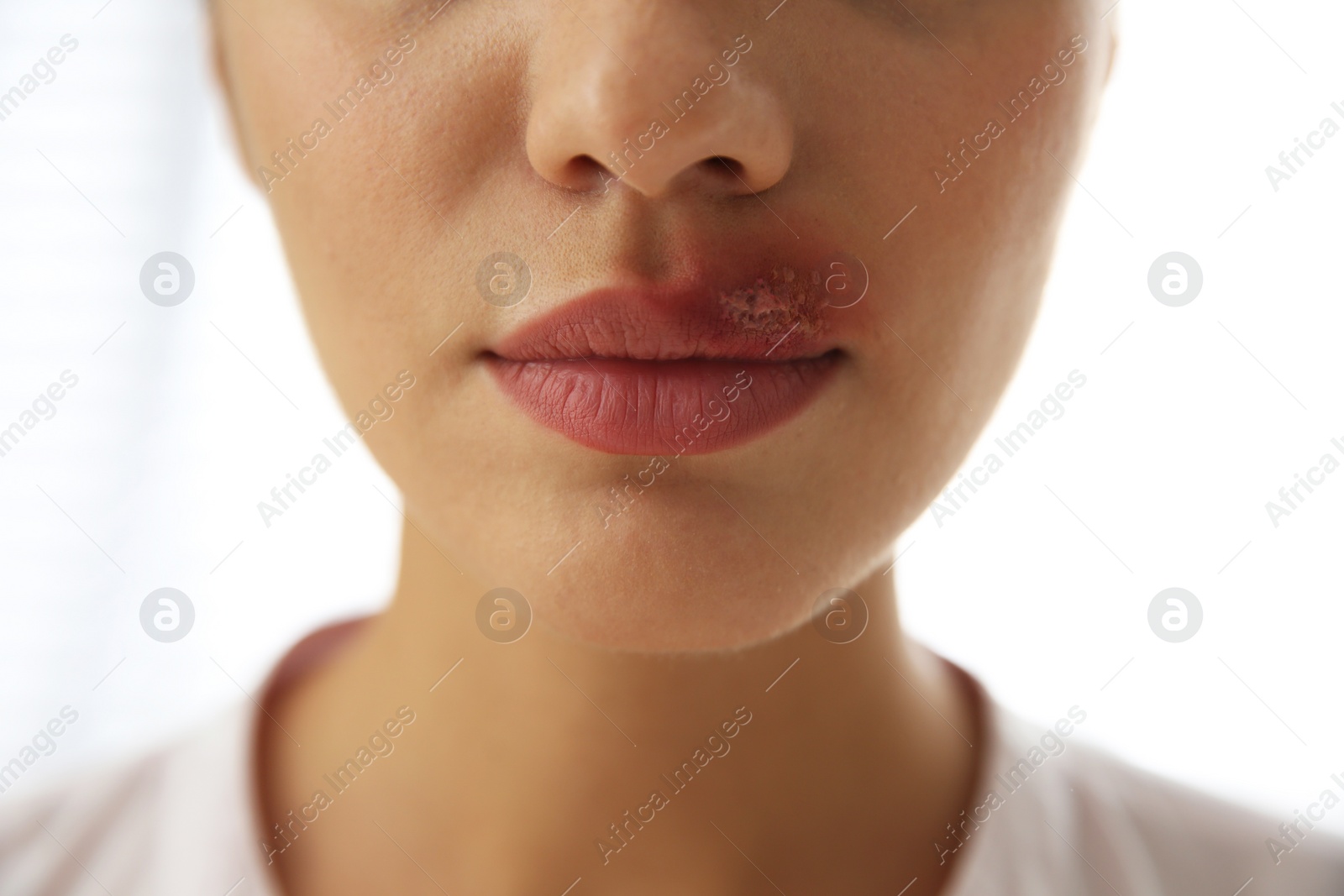 Photo of Woman with herpes on lip against light background, closeup