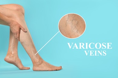 Image of Woman suffering from varicose veins on light blue background, closeup. Magnified skin surface showing affected area