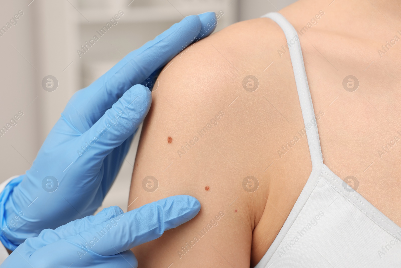 Photo of Dermatologist examining patient's birthmark indoors, closeup view