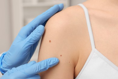 Dermatologist examining patient's birthmark indoors, closeup view