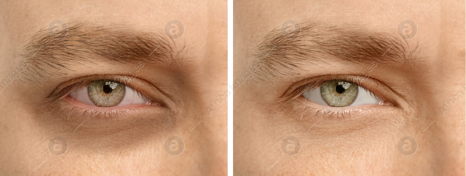 Image of Collage with photos of tired man with dark circle under eye and after rest, closeup. Banner design