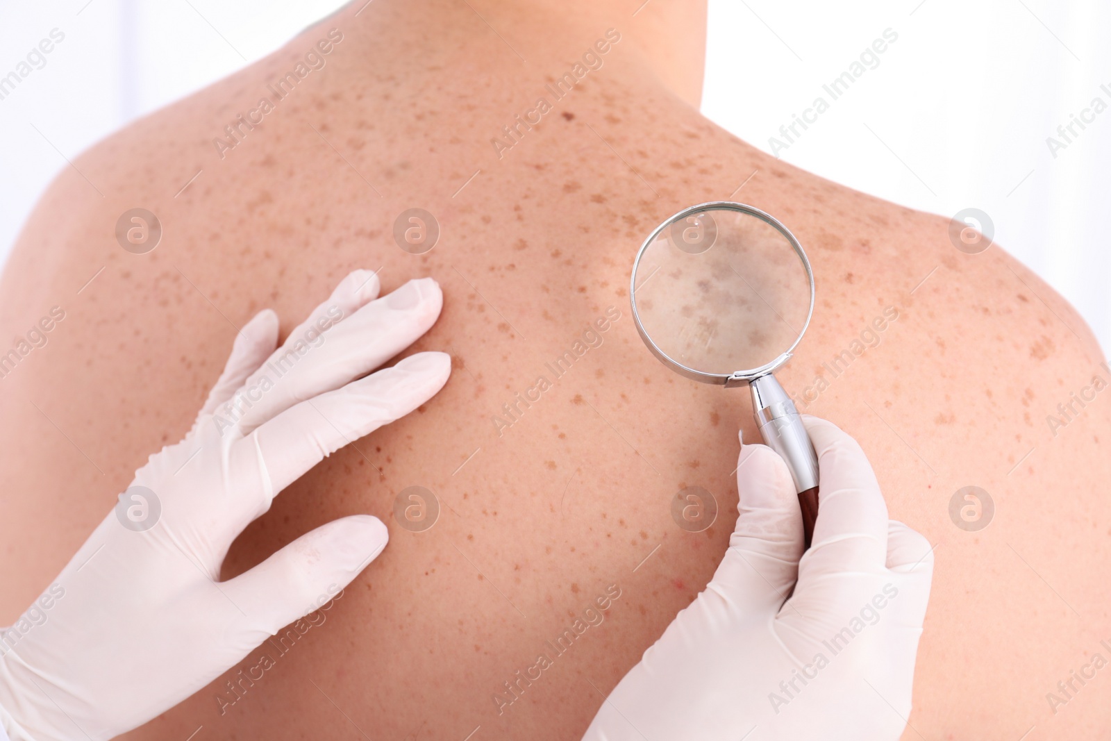 Photo of Dermatologist examining patient with magnifying glass in clinic, closeup view