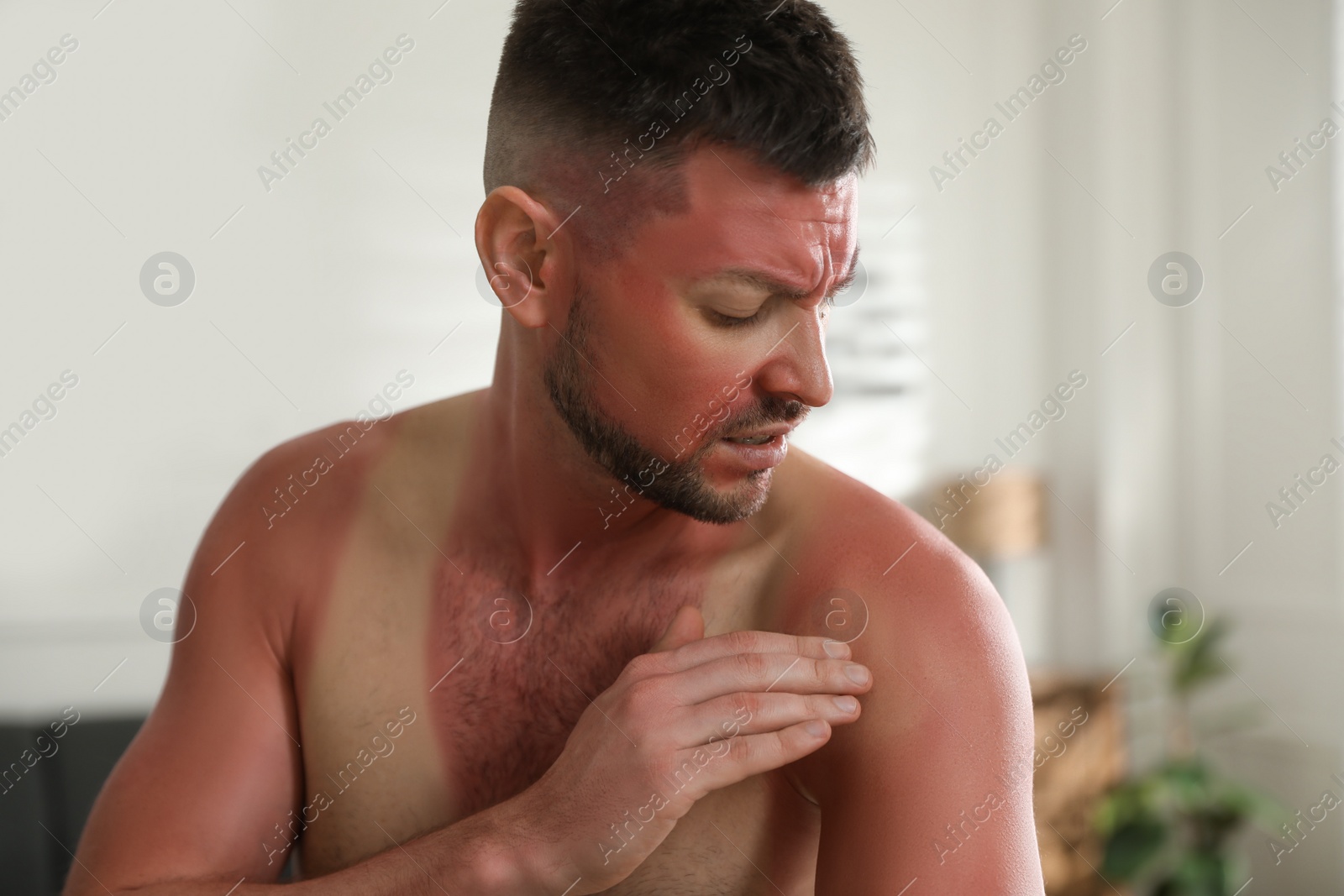 Photo of Man with sunburn on skin at home