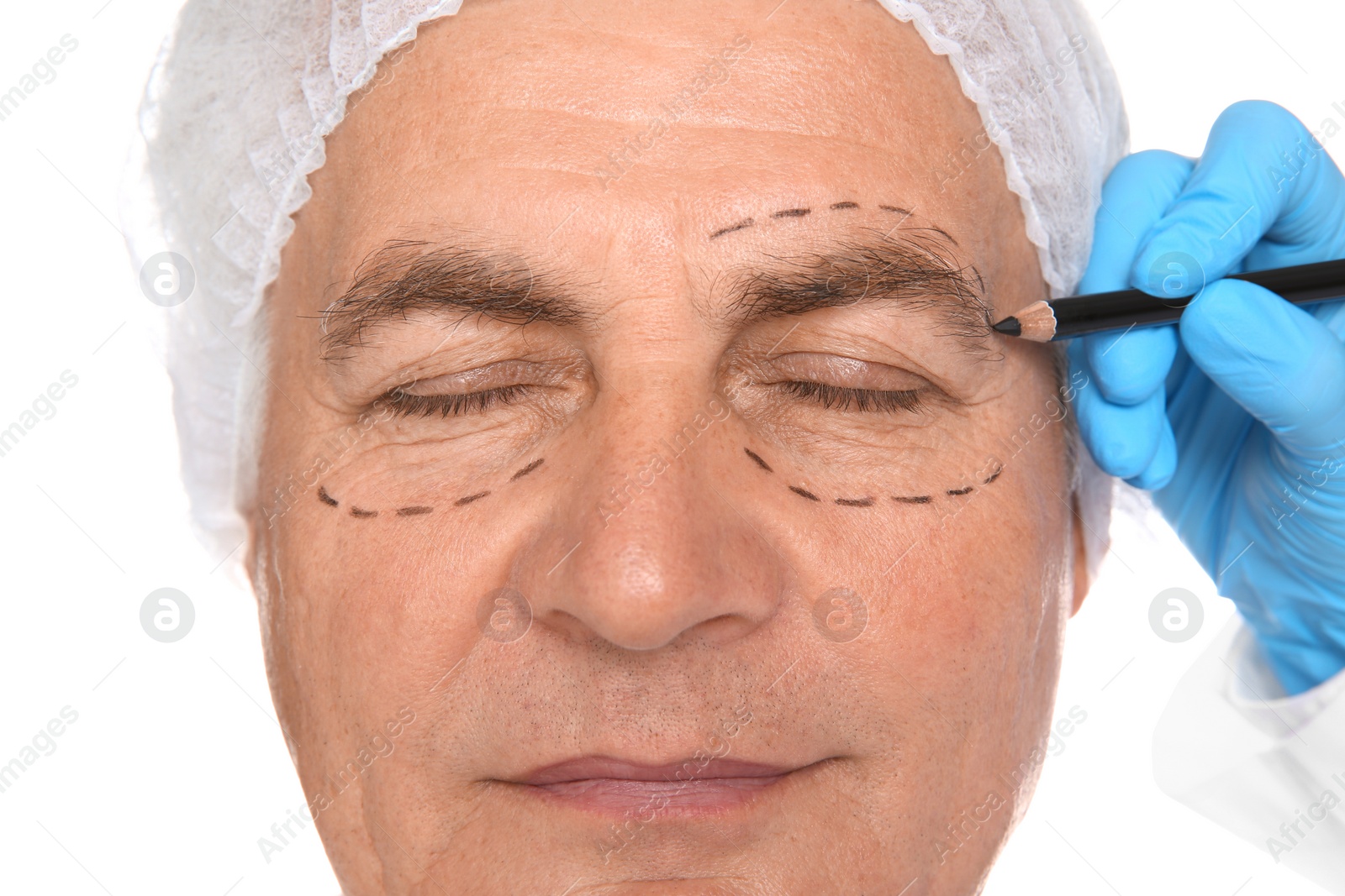 Photo of Doctor marking senior man face before cosmetic surgery on white background