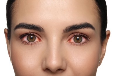 Image of Woman with red eyes suffering from conjunctivitis on white background, closeup