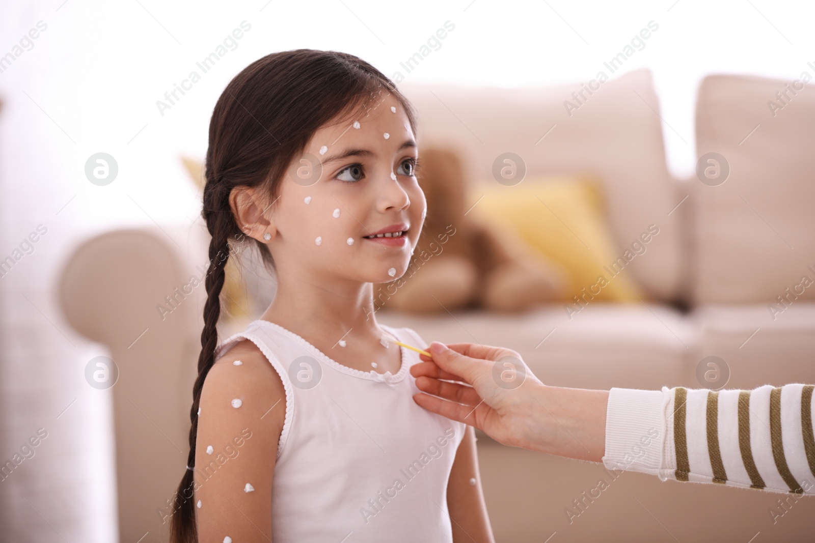 Photo of Mother applying cream onto skin of her daughter with chickenpox at home