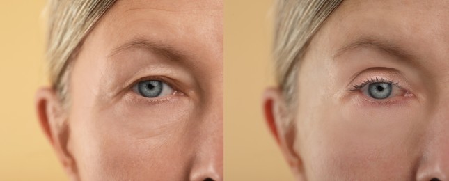 Image of Aging skin changes. Woman showing face before and after rejuvenation, closeup. Collage comparing skin condition