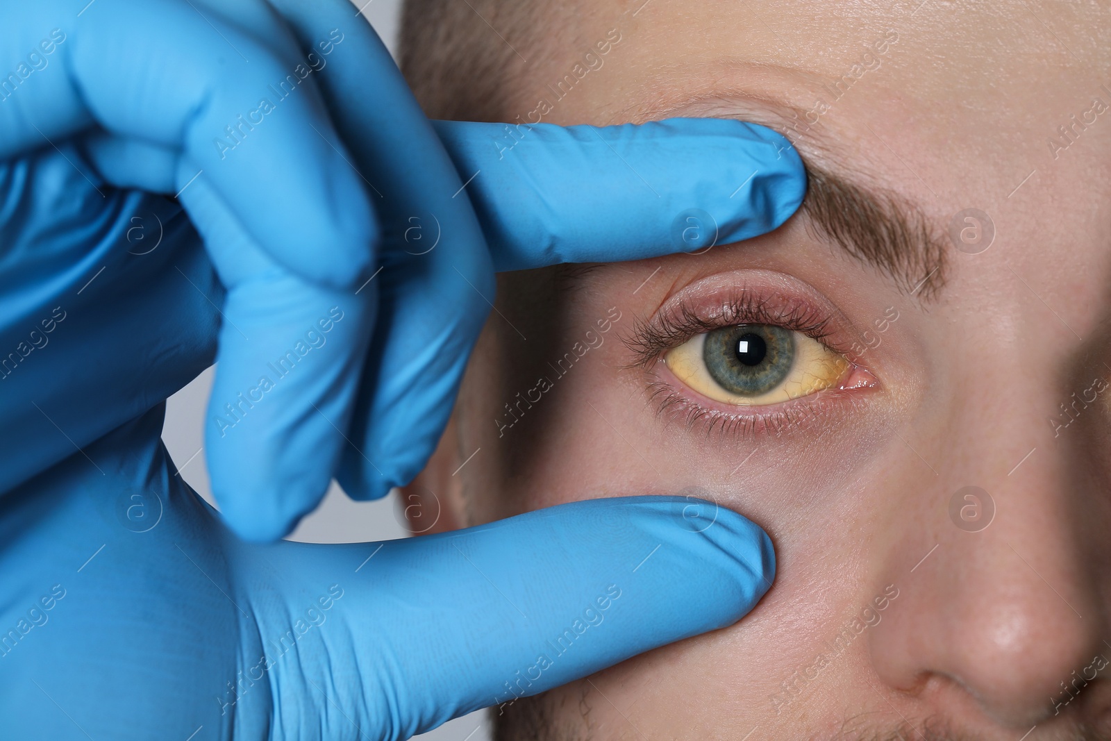 Photo of Doctor checking yellow eyes of patient on light grey background, closeup. Hepatitis symptom