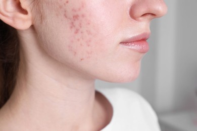 Woman with acne problem at home, closeup