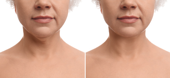 Mature woman before and after plastic surgery operation on white background, closeup. Double chin problem