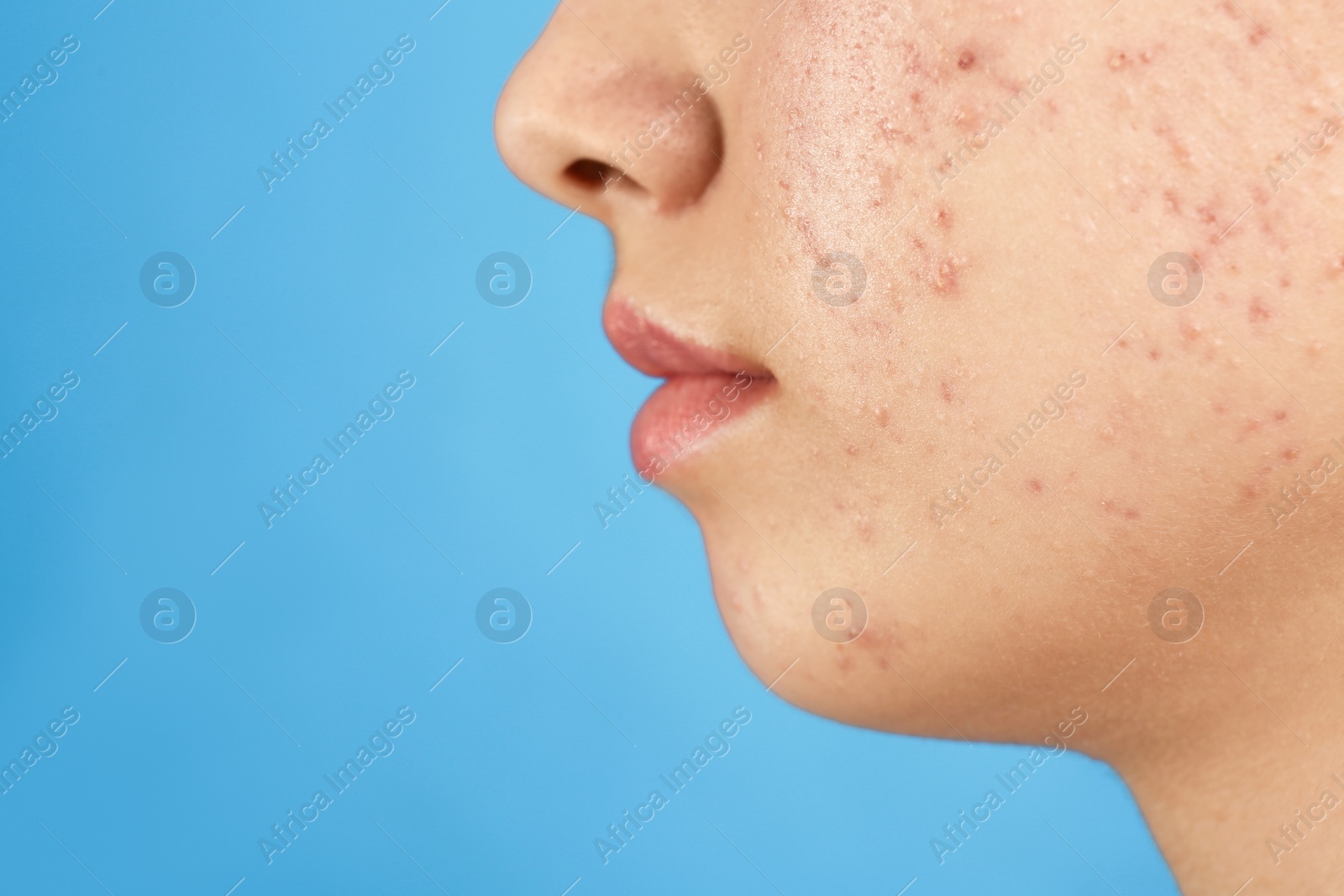 Photo of Teenage girl with acne problem on blue background, closeup