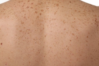 Photo of Closeup of man's body with birthmarks as background