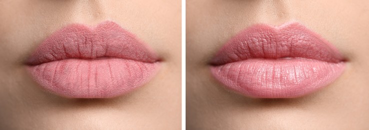 Image of Collage with photos of woman with dry and moisturized lips, closeup. Banner design