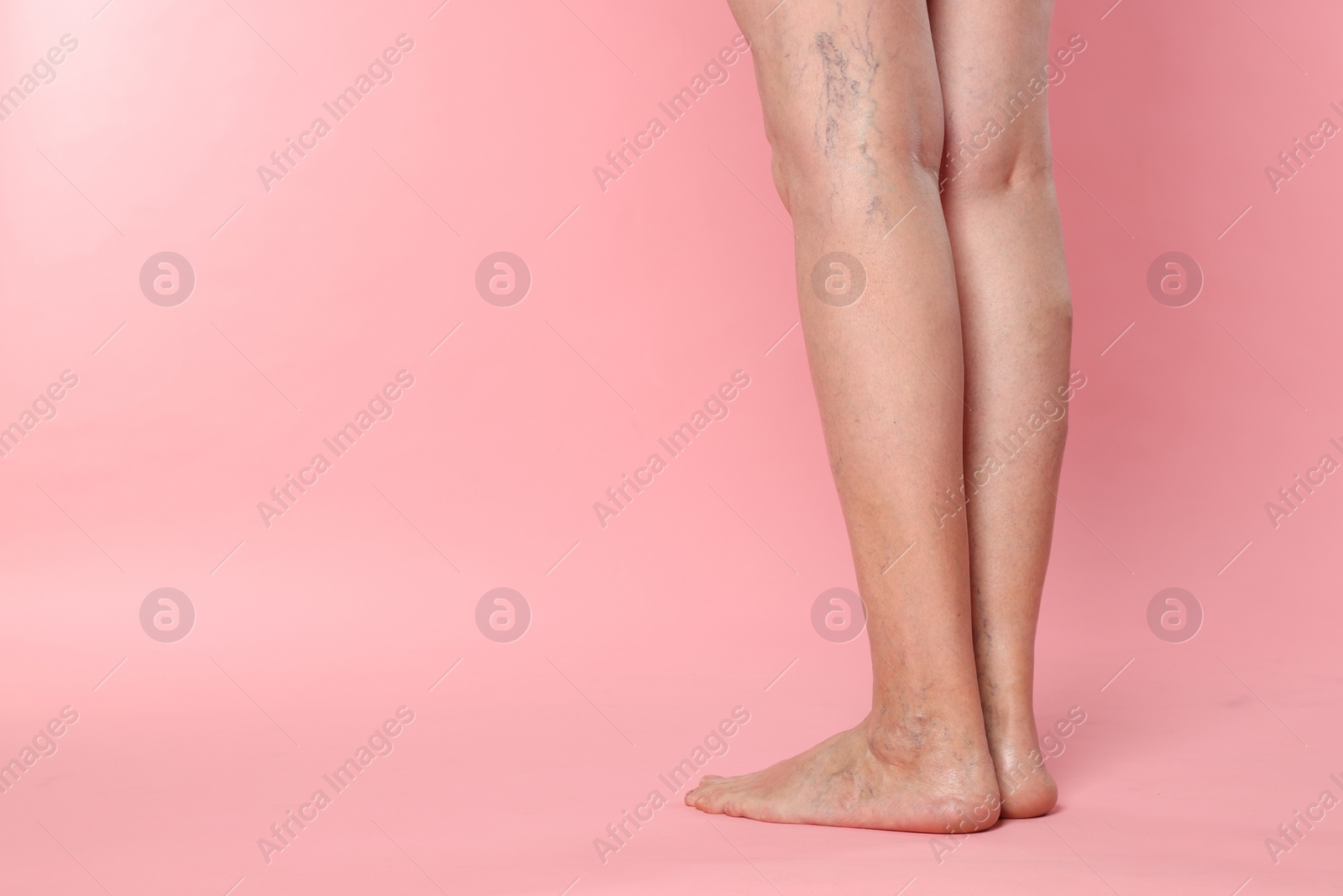 Photo of Closeup view of woman with varicose veins on pink background. Space for text