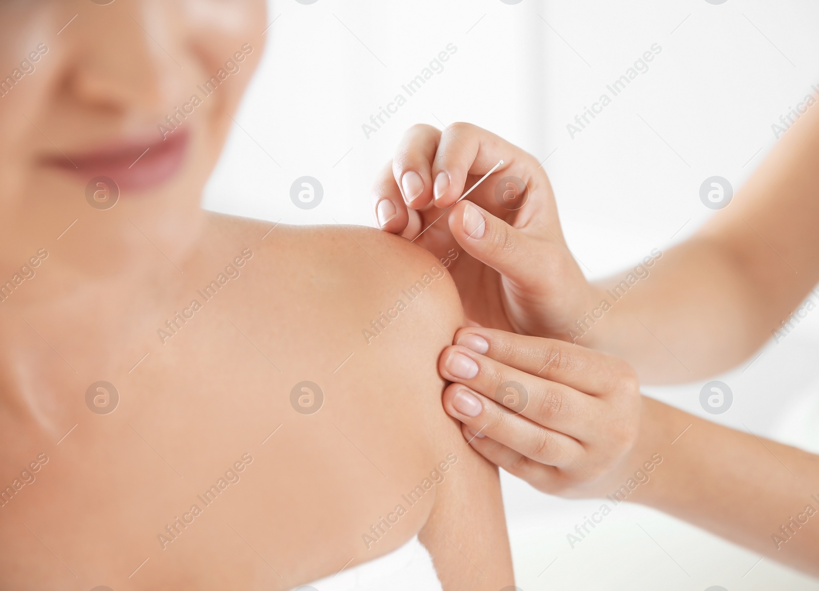 Photo of Young woman undergoing acupuncture treatment in salon, closeup