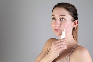 Photo of Young woman with acne problem applying cosmetic product onto her skin on light grey background. Space for text