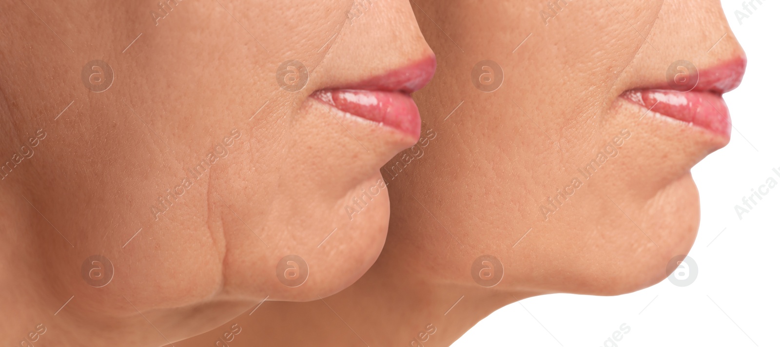 Image of Double chin problem. Collage with photos of mature woman before and after skin tightening treatments on white background, closeup