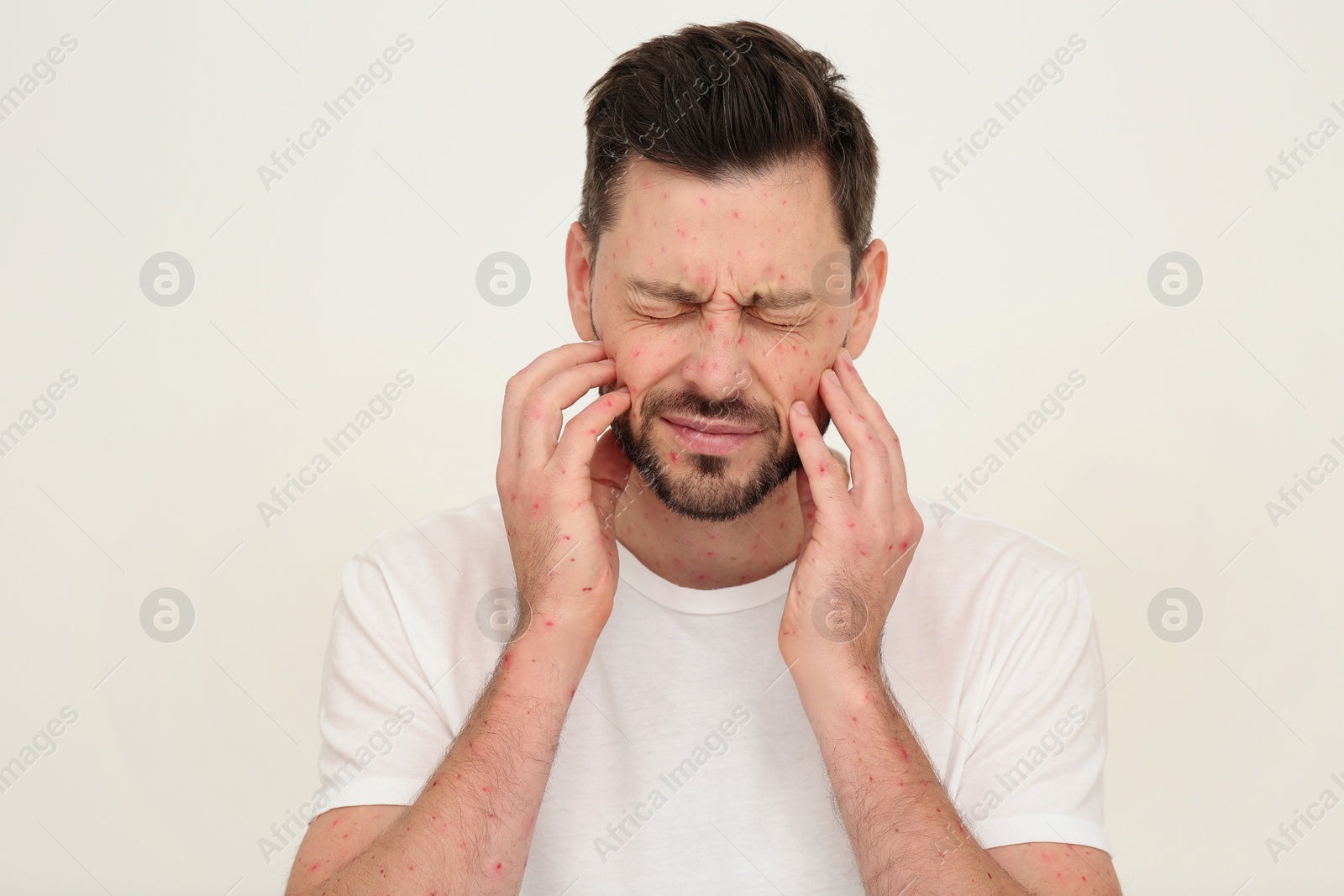 Photo of Man with rash suffering from monkeypox virus on beige background